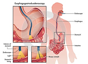 Esophagogastroduodenoscopy