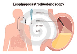 Esophagogastroduodenoscopy. Medical diagnostics of the esophageal, stomach