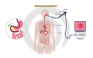 Esophagogastroduodenoscopy medical procedure