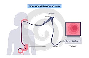 esophagogastroduodenoscopy medical procedure