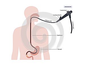 esophagogastroduodenoscopy medical procedure