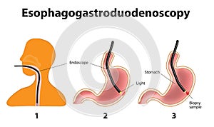 Esophagogastroduodenoscopy or oesophagogastroduode