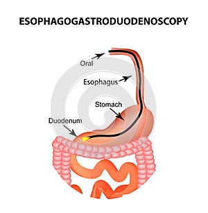 Esophagogastroduodenoscopy. Upper endoscopy. Fibrogastroscopy. Diagnosis of esophageal, stomach, duodenum, intestine, colon