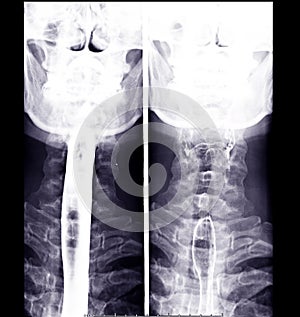 Esophagram or Barium swallow AP view.