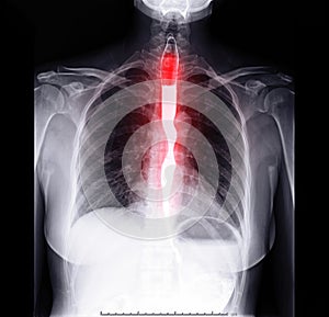 Esophagram or Barium swallow Front view showing esophagus for diagnosis GERD.