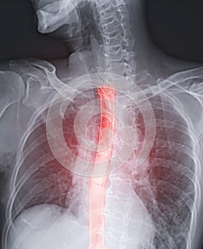 Esophagram or Barium swallow  image   showing Esophageal stent placement for patient  Esophageal cancer