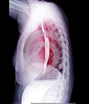 Esophagram or Barium swallow Lateral view .