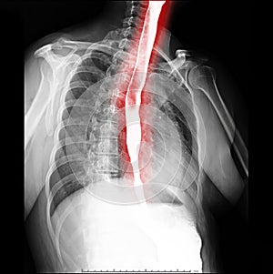 Esophagram or Barium swallow oblique view showing esophagus for diagnosis GERD.