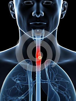 Esophagus cancer