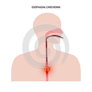 Esophagus endoscopy procedure
