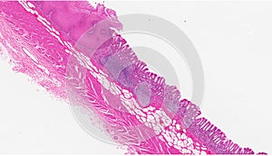 Esophagus stomach junction