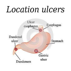 Esophagus ulcer affected. Ulcer of esophagus