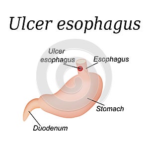 Esophagus ulcer affected. Ulcer of esophagus