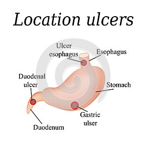 Esophagus ulcer affected. Ulcer of esophagus photo