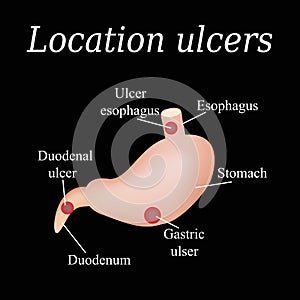 Esophagus ulcer affected. Ulcer of esophagus. Stomach ulcer affected. Gastric ulcer. Duodenum ulcer affected. Vector
