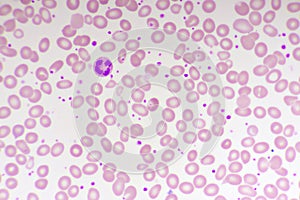 Essential thrombocytosis blood smear