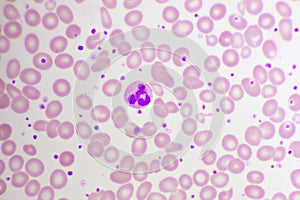 Essential thrombocytosis blood smear