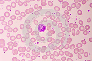 Essential thrombocytosis blood smear