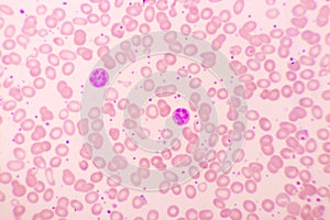 Essential thrombocytosis blood smear photo