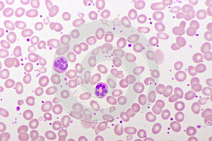 Essential thrombocytosis blood smear