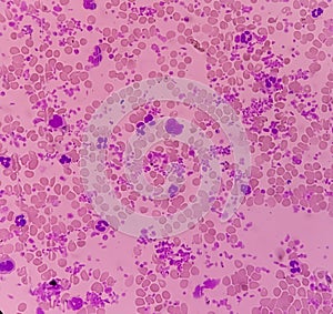Essential thrombocytosis blood smear showing abnormal high volume of platelet and White Blood Cells. Panmyelosis.