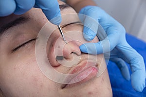 An esthetician uses a comedone extractor to dislodge blackheads from a patient\'s nose. Facial procedure and treatment