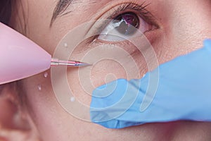 An esthetician uses a mini wireless cautery machine to remove warts under the eye of a female patient at an aesthetic center