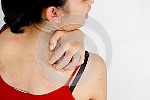 Ethic young woman back with itchy skin