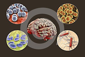 Etiology of bacterial meningitis