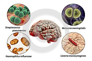 Etiology of bacterial meningitis
