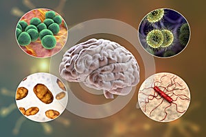 Etiology of bacterial meningitis