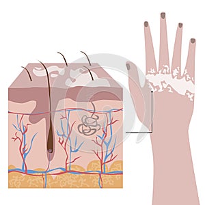 European hand with vitiligo and anatomical structure of skin cells with melanin problems, flat vector stock illustration with