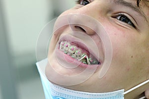 An even row of teeth in braces