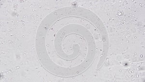 Examination biological material of human semen under microscope in magnification of 200 spermatozoa