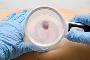 Examination of a mole on the patient`s body. The concept of studying moles to prevent the development of skin cancer or melanoma photo