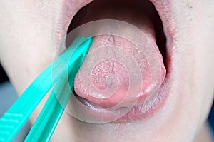 Examination of the patient`s tongue, tongue disease, examination of the dentist, otolaryngologist