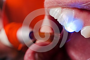 Examination of teeth vitality with UV lamp photo