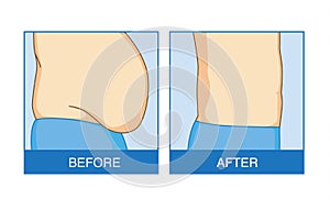 Before and after of excess abdominal fat to flat.