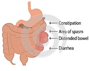 Excess gas from human body.Irritable bowel syndrome IBS in a large intestine vector illustration