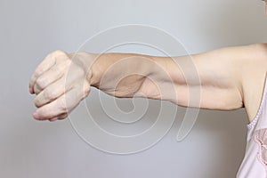 An excess loose skin on an arm of a senior elderly woman after extreme weight loss