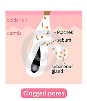 Sebum plugs causes clogged pores, which lead to acne. Skin care concept photo