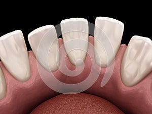 Excessive Spacing between teeth. Dental 3D illustration concept