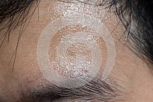 Excessive sweating or hyperhidrosis and oily skin at forehead of Asian, Myanmar or Chinese adult young man