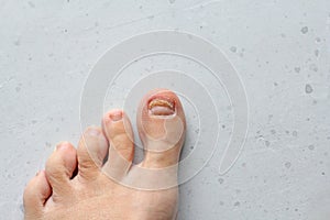 Exfoliation of nail on big toe, close-up in woman, girl. Toenail damage, fungus, trauma, big toe nail problems, nail detachment,