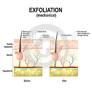 Exfoliation or peel is cosmetic procedures