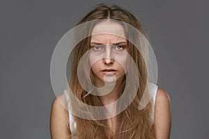 Exhausted Young Woman With Bruises Under Eyes