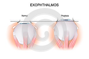 Exophthalmos. comparison and difference photo