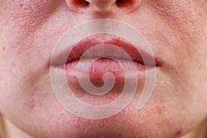 Expanded pores, acne, comedones, black spots. Lips close up. Problem skin girl