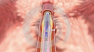 The expanded stent restores blood flow and will remain in the artery after the coronary stenting procedure.