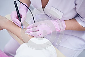 Experienced Caucasian beauty clinic doctor removing nevus on female arm